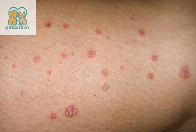 Bệnh Nấm Mèo Ở Người