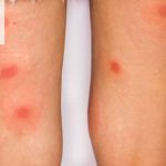Triệu Chứng Của Bệnh