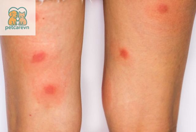 Triệu Chứng Của Bệnh